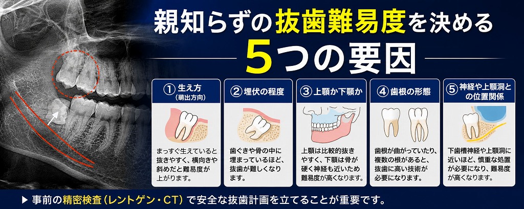 親知らずの抜歯難易度を決める5つの要因