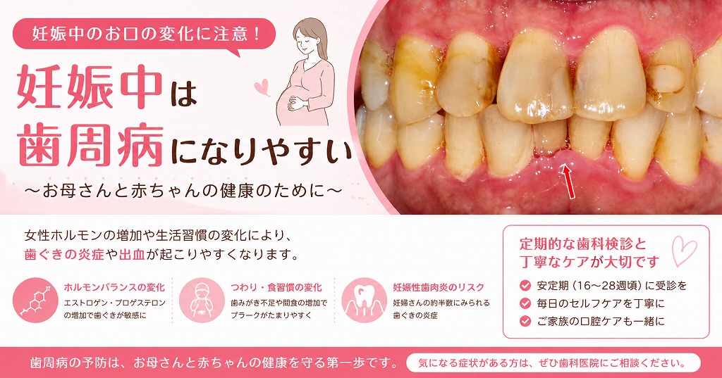 妊娠中は歯周病になりやすい