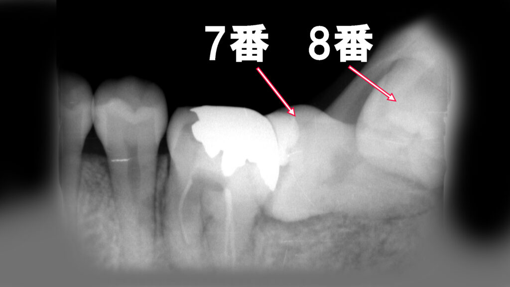 第2大臼歯(7番)と第3大臼歯(8番=親知らず)のが水平埋伏