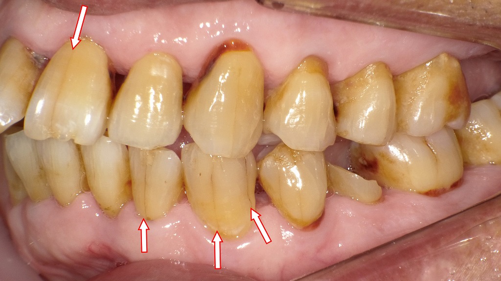 マイクロクラックの症例