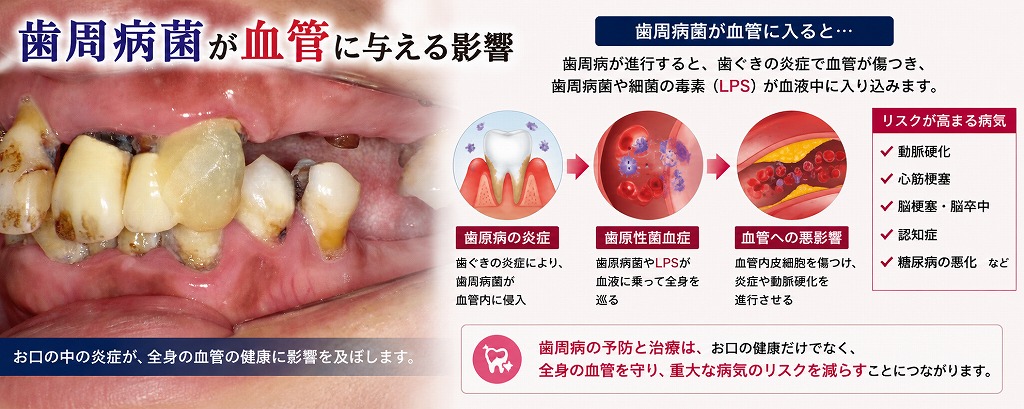 歯周病菌が血管に与える影響