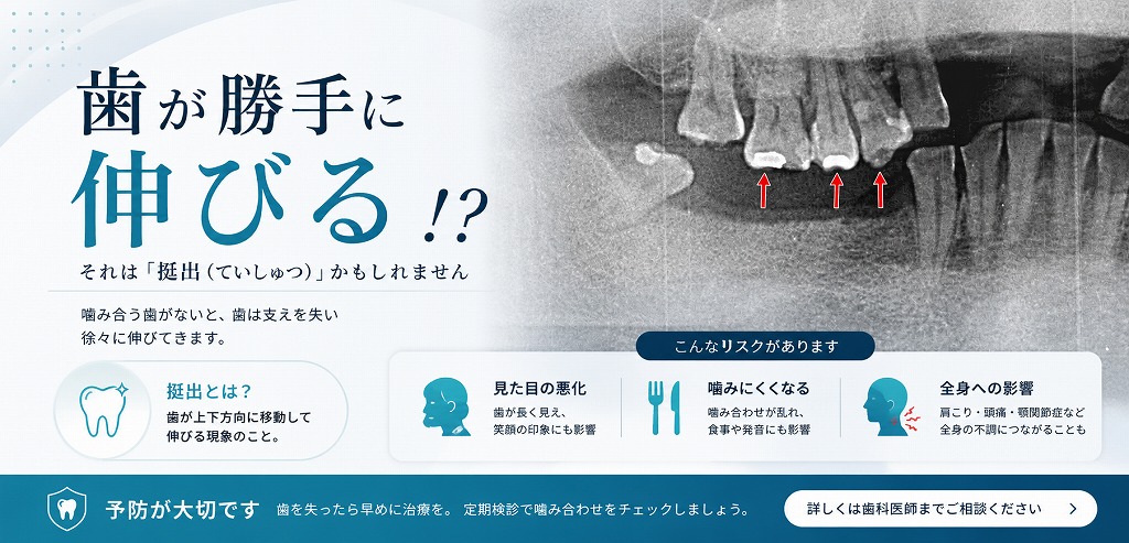 歯が勝手に伸びる「挺出」