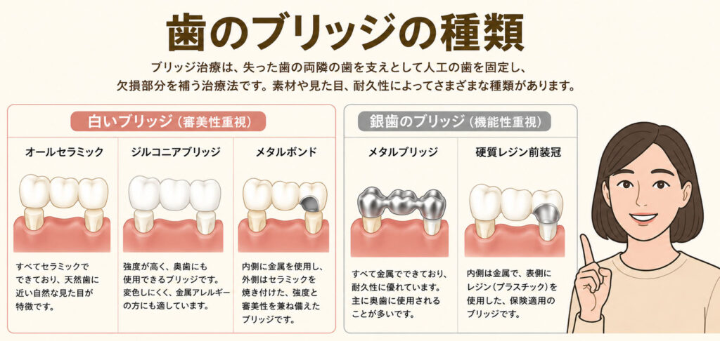 歯のブリッジの種類