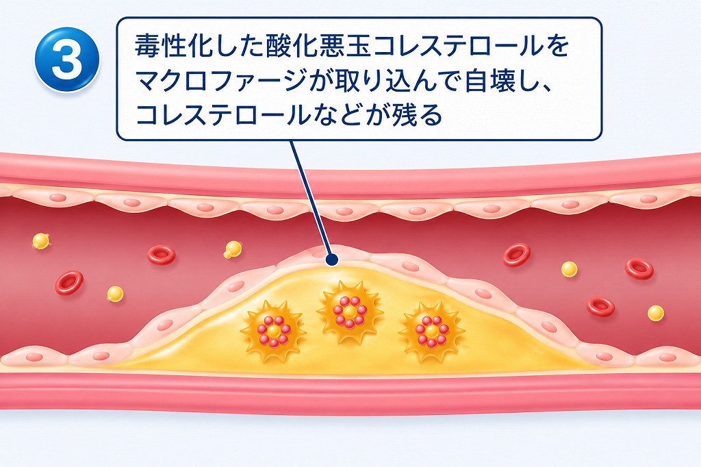 プラークが形成される