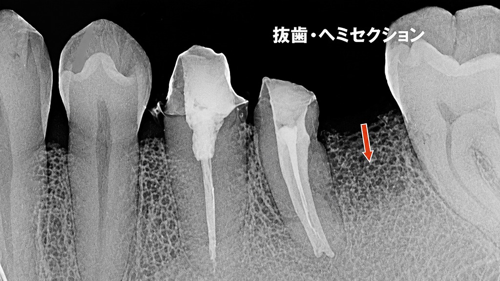 下顎第1大臼歯の遠心根をヘミセクション