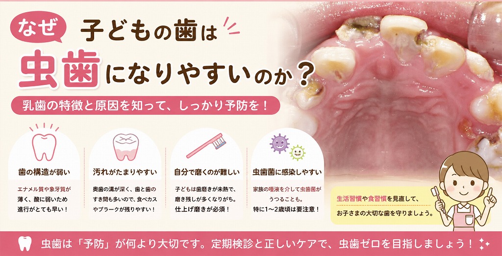 なぜ子どもの歯は虫歯になりやすいのか