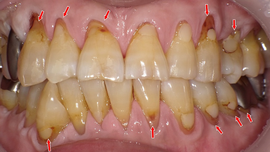 歯の根が見えてしまったところにプラークが溜まり、茶色い根面う蝕が多発している症例