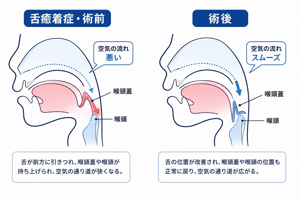舌癒着症の術前・術後　日本舌癒着症学会より引用改変