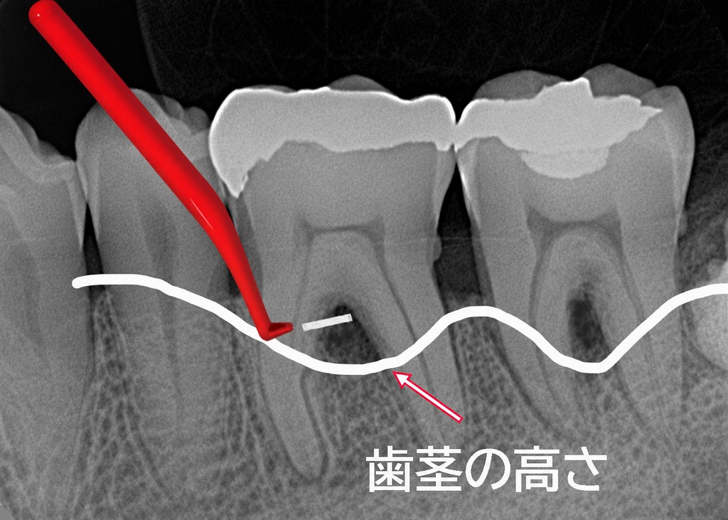 歯間ブラシでメインテナンス
