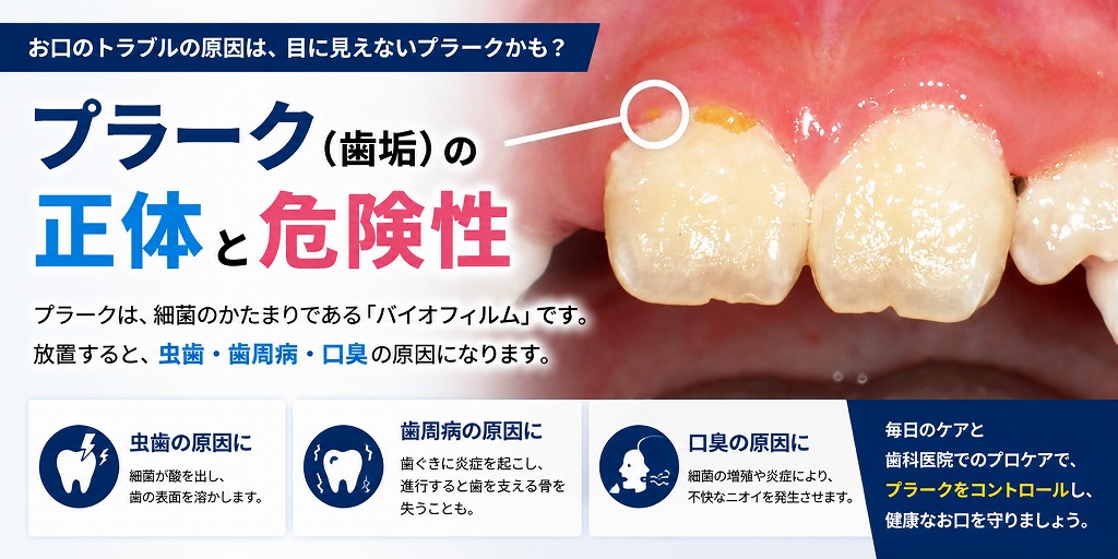 プラーク（歯垢）の正体と危険性