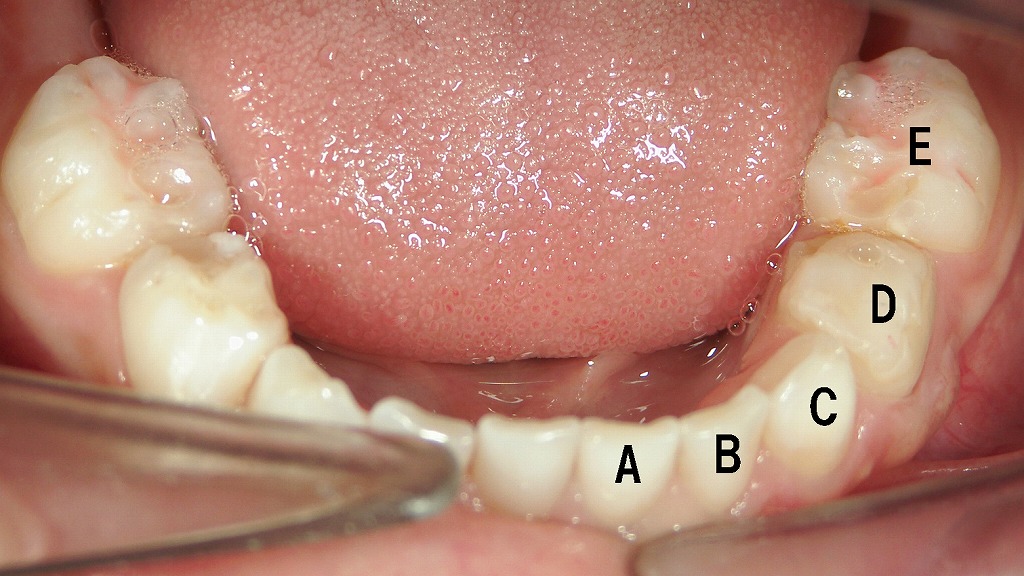 乳歯列：咬合面観