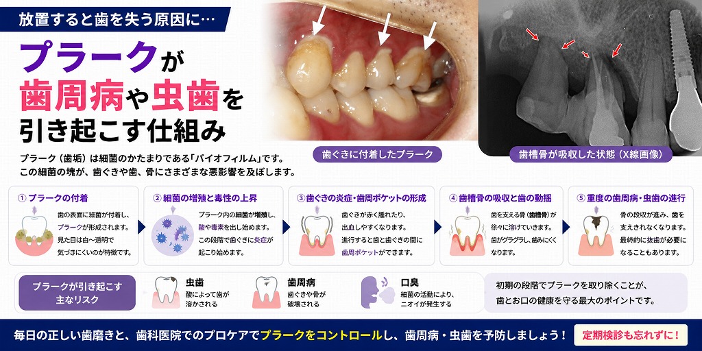 プラークが歯周病や虫歯を引き起こす仕組み