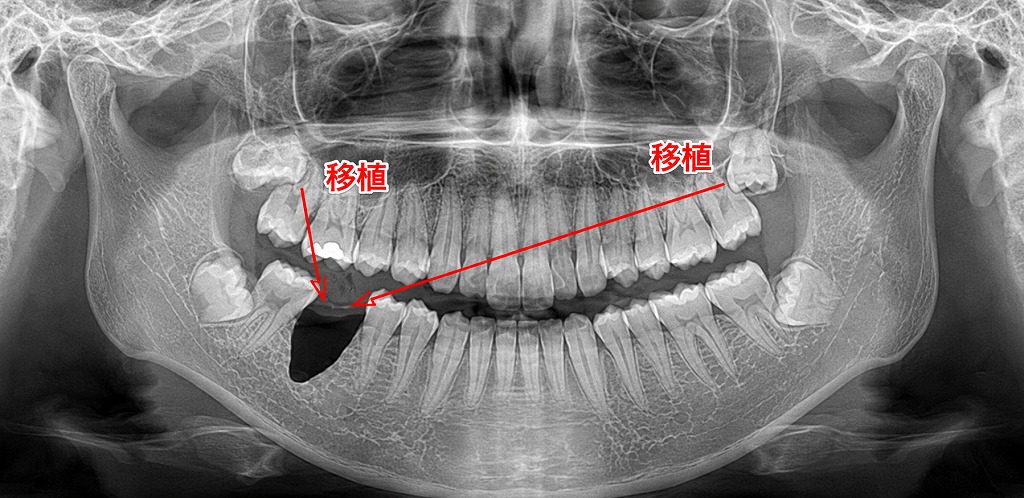 親知らずが“使える歯”になる⁉︎ 移植ドナーとしてのメリット