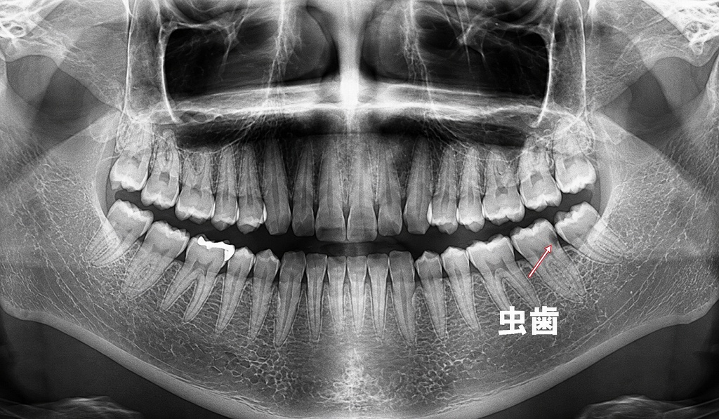 下顎7番の虫歯が見つかる