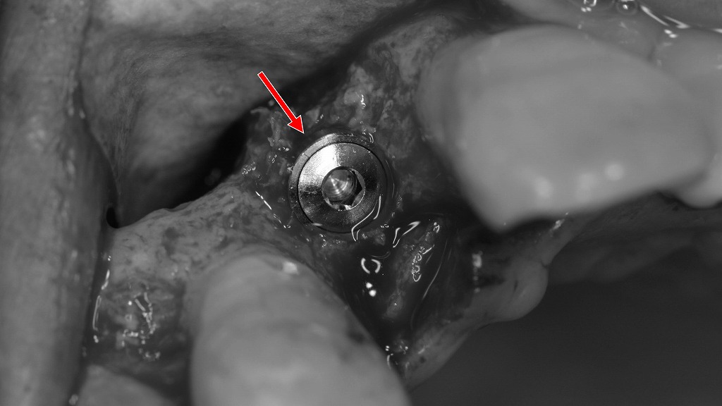 インプラント体（フィクスチャー）の埋入