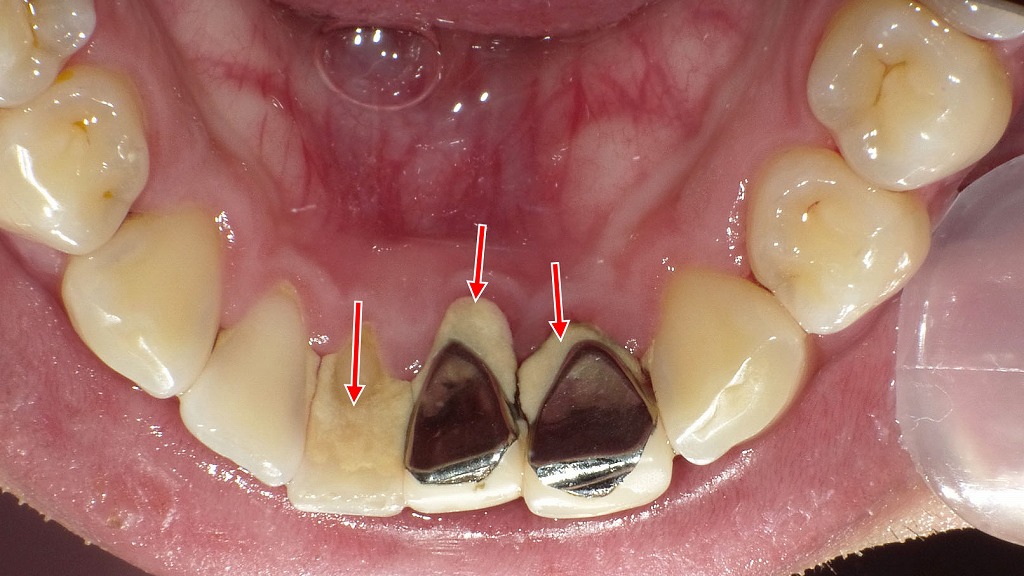 下顎前歯部の前装冠周囲に、多量の歯石沈着が認められる症例