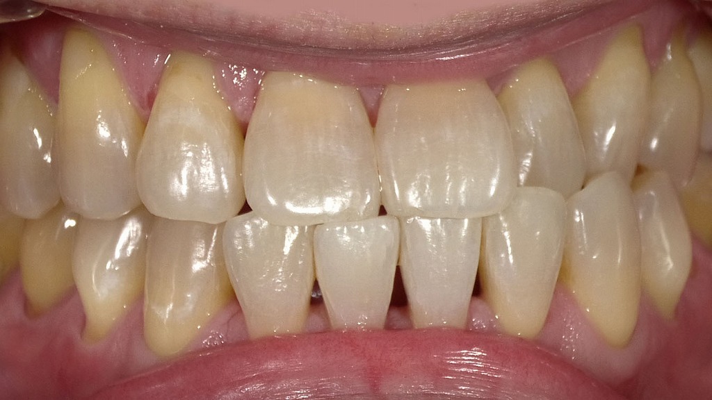 白さへの気づきが変える習慣｜ホワイトニング後の口元