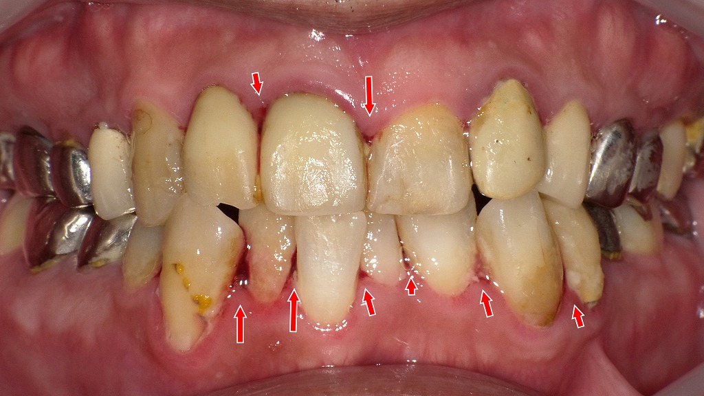 歯ぐきが腫れて血が出る本当の理由｜強い炎症とプラーク蓄積が招くサイン