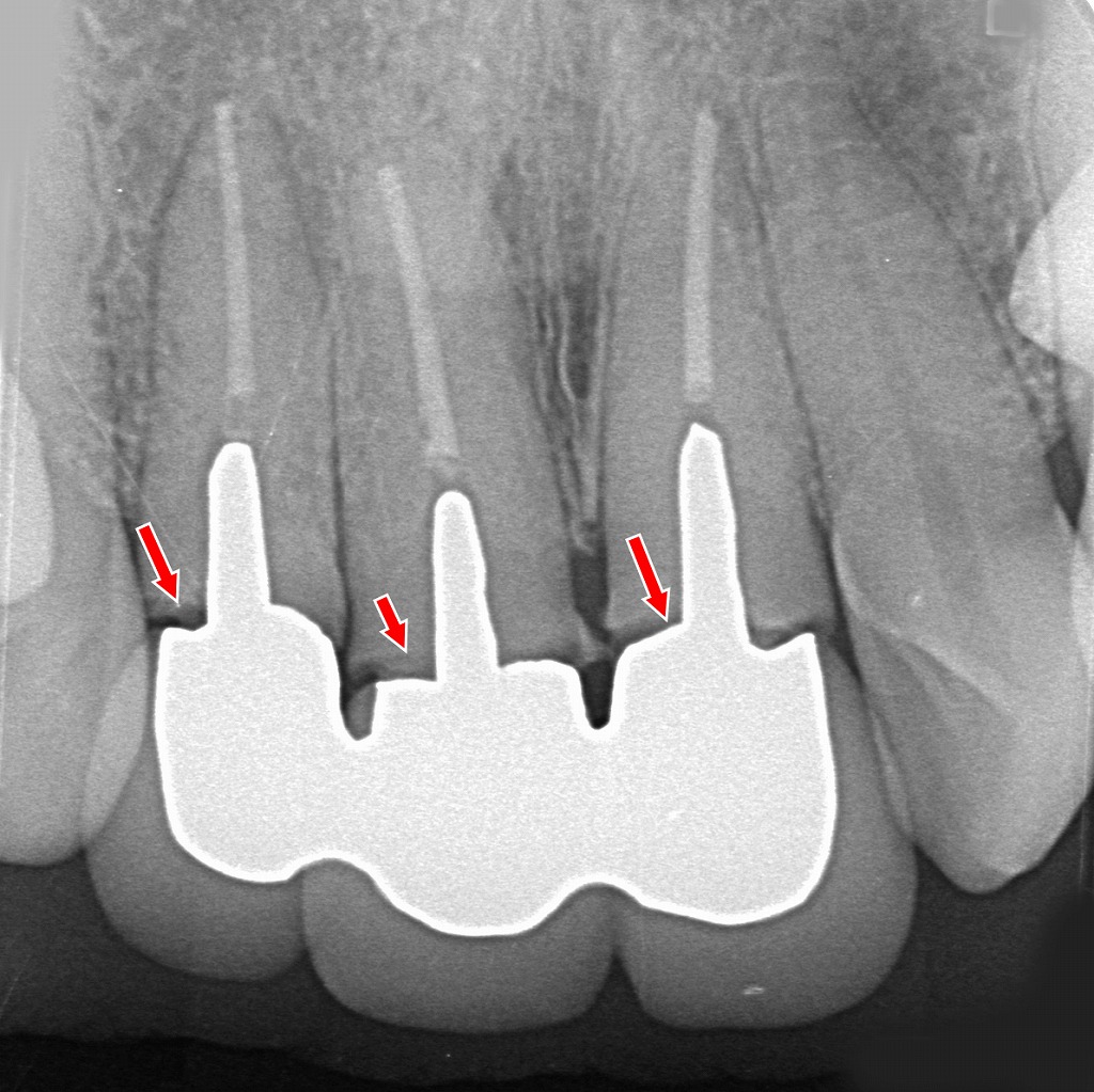 赤矢印部で、連結クラウンの支台歯の根がいずれも破折している様子が確認できます。