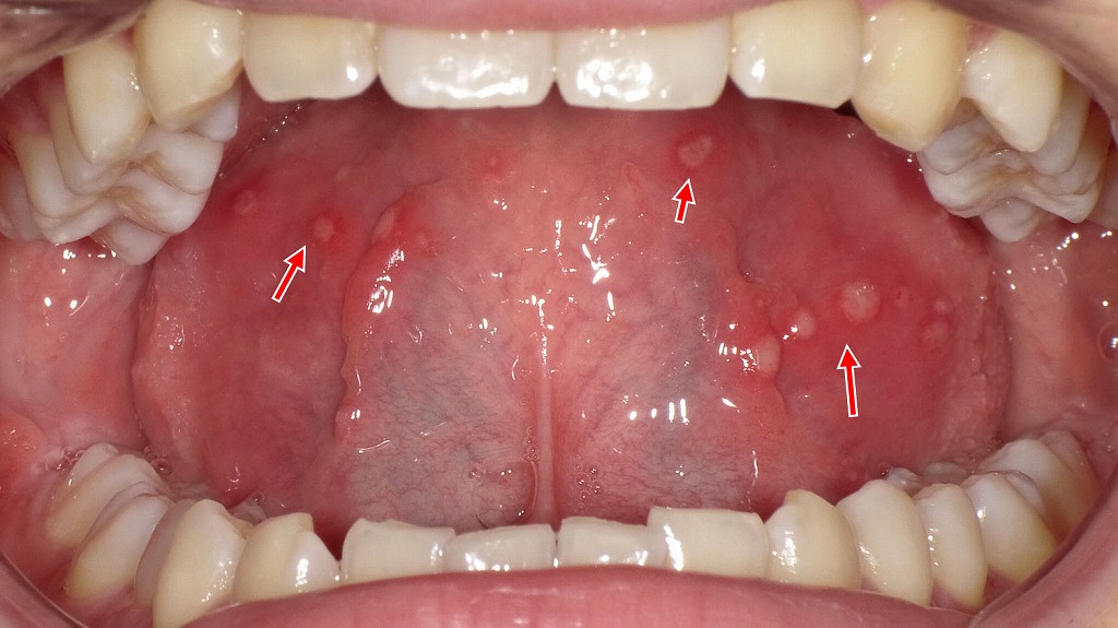 ウイルス性口内炎（ヘルペス性口内炎）｜多発する小潰瘍と強い粘膜炎症