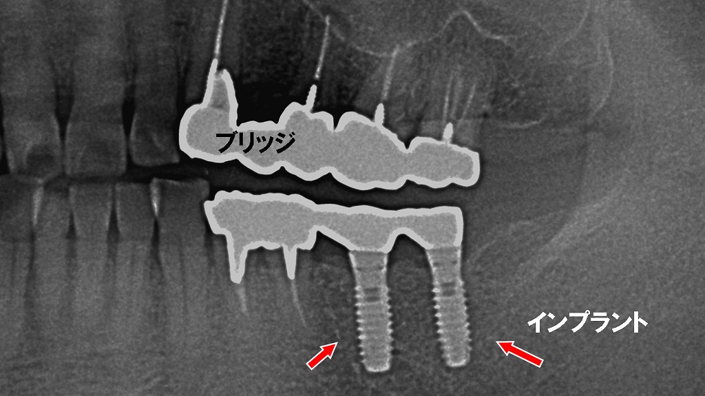 欠損放置による噛み合わせの崩れと治療選択肢(インプラント・ブリッジ)