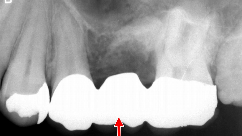 上顎5・6・7番ブリッジ