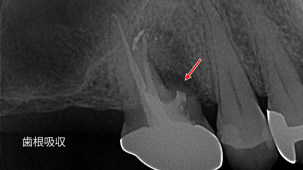 上顎６番近心根の歯根吸収