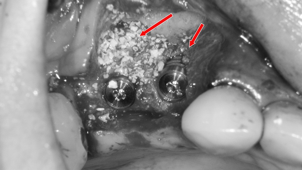 GBR法による骨造成:骨欠損部への人工骨填入