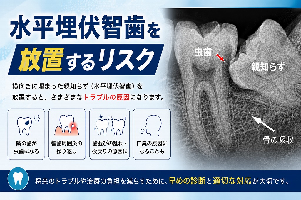 水平埋伏智歯とは？放置するリスクと抜歯が必要なケースを歯科医師が解説