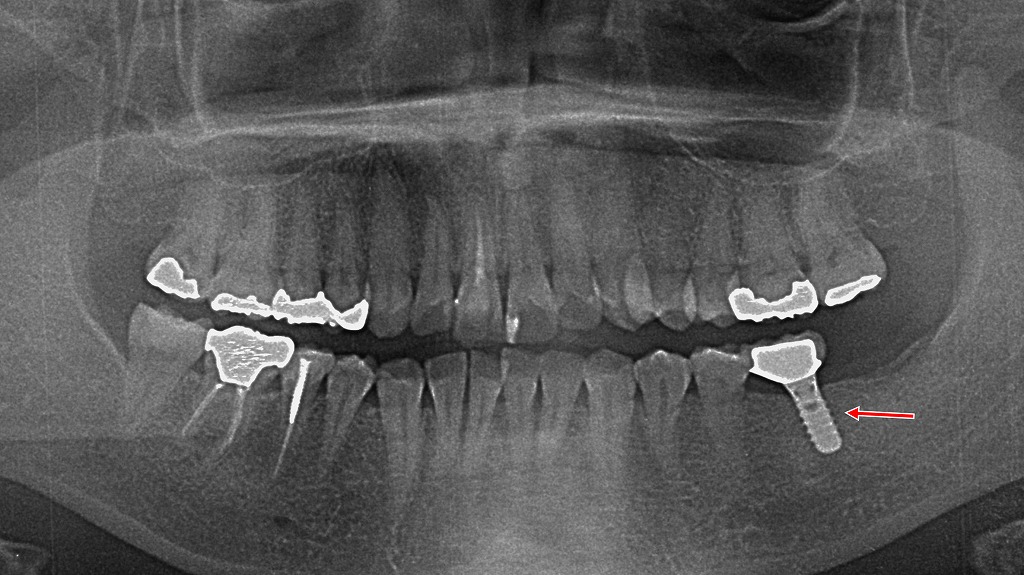 🦷 抜歯後の選択肢 ― インプラントによる機能回復
