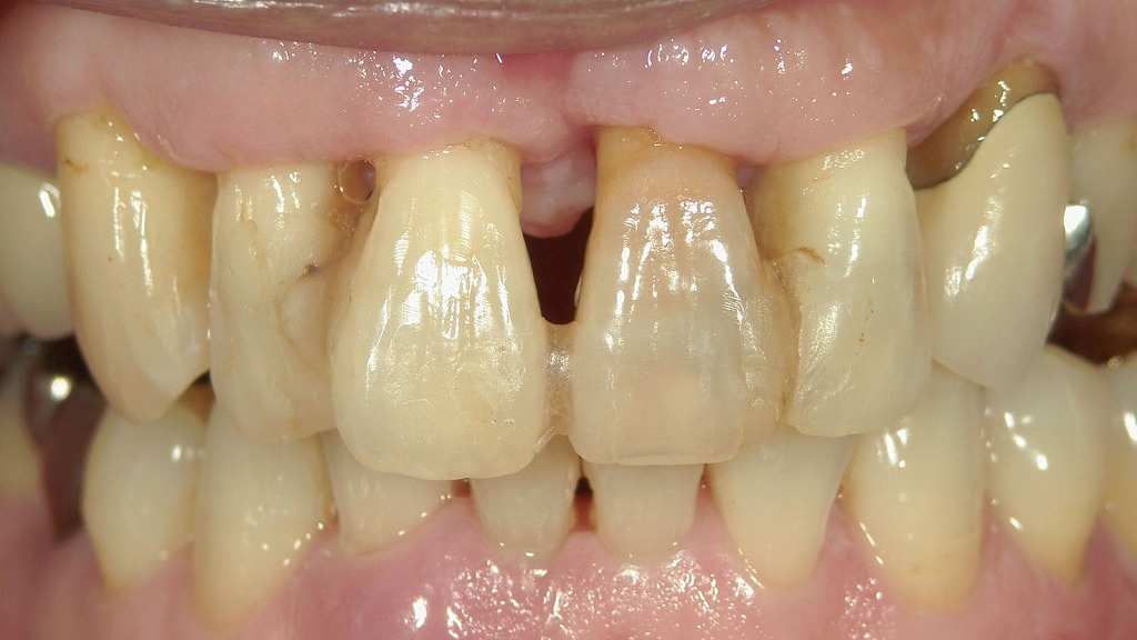 歯周外科手術後:歯肉退縮