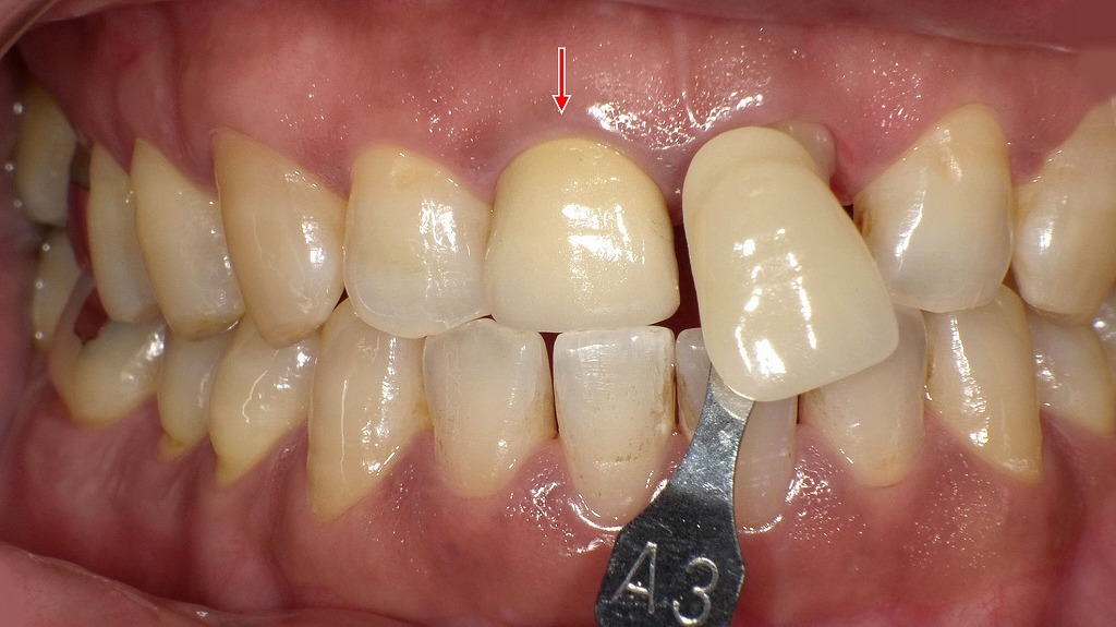 右上1番はオールセラミッククラウンで修復完了｜左上1番はシェードテイキング