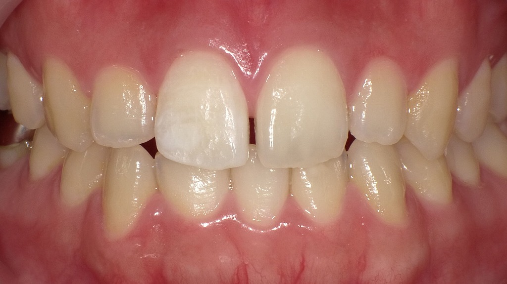 アイコン（Icon）治療によるホワイトスポットの審美改善（治療後）