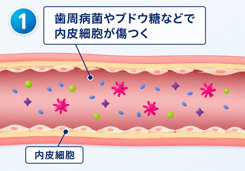 血管内皮細胞が傷つく