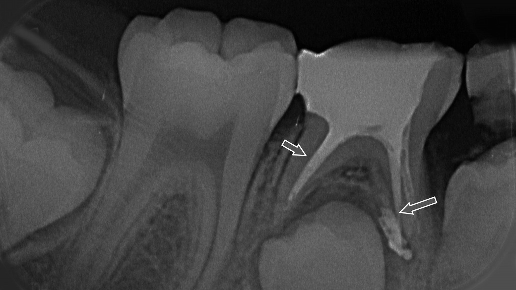 乳歯の抜髄後、根の中に薬剤を充填した状態を示すX線画像。