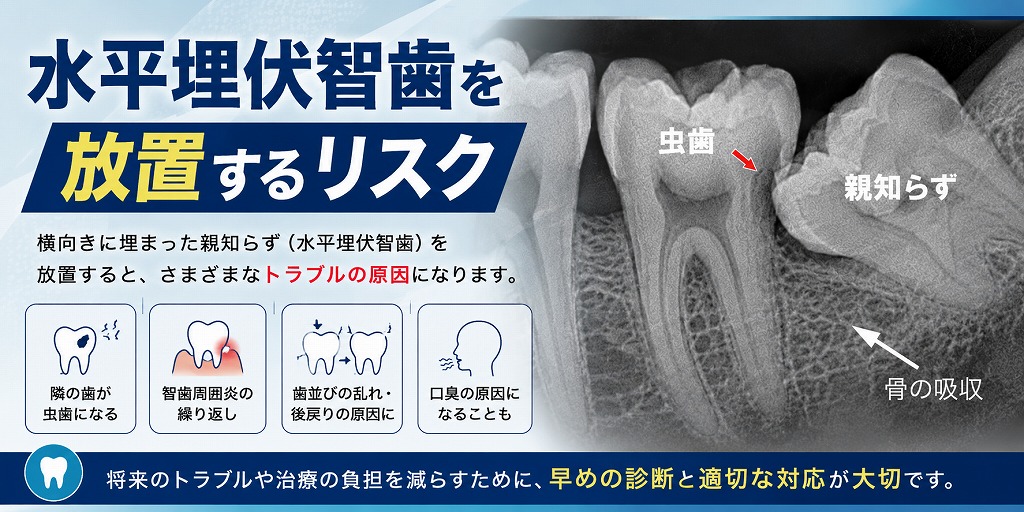 水平埋伏智歯を放置するリスク