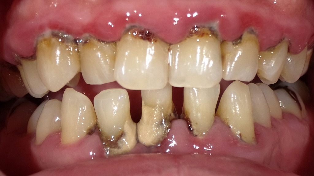 歯周病ケアに使われる殺菌水