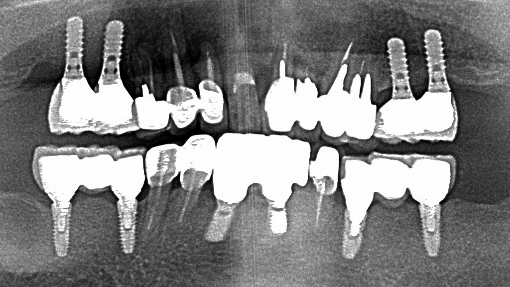 インプラント周囲をやさしく清掃｜エアフローの効果