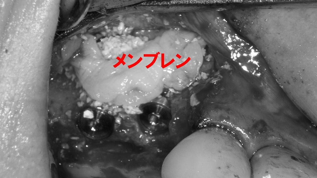 GBR法におけるメンブレンの設置:骨補填材の保護と再生スペースの確保