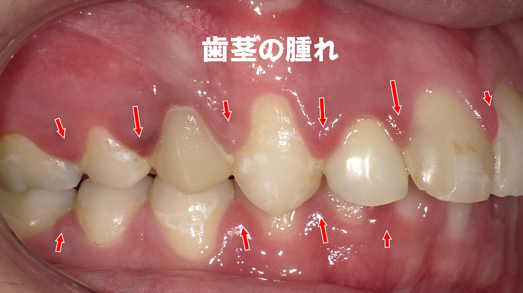 歯間部の腫れは歯肉炎のサイン。口臭悪化の前に対策を。