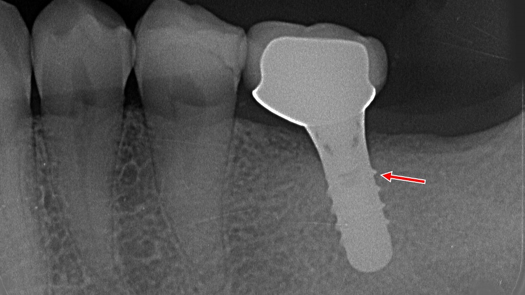 口腔機能低下症へのアプローチ ― インプラントによる噛む力の回復