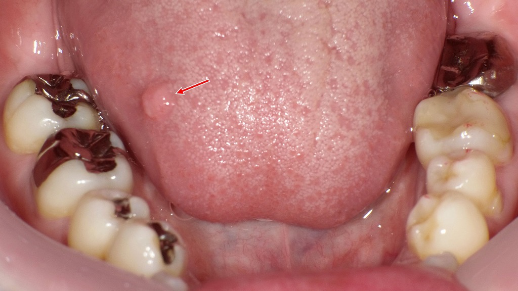 舌側に認められる口腔線維腫の所見