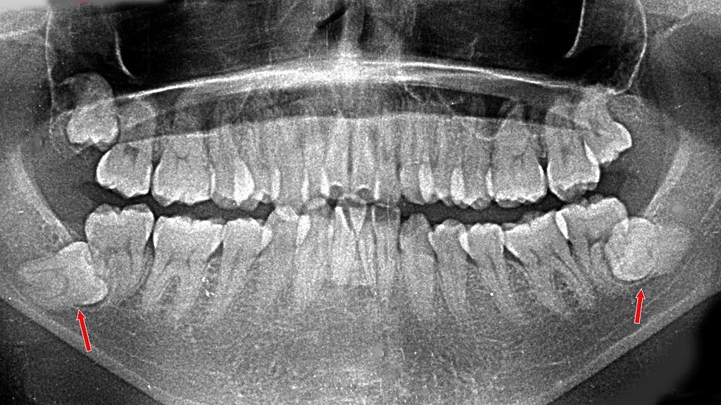 骨の中に眠る埋伏智歯：下歯槽神経と近接したケース