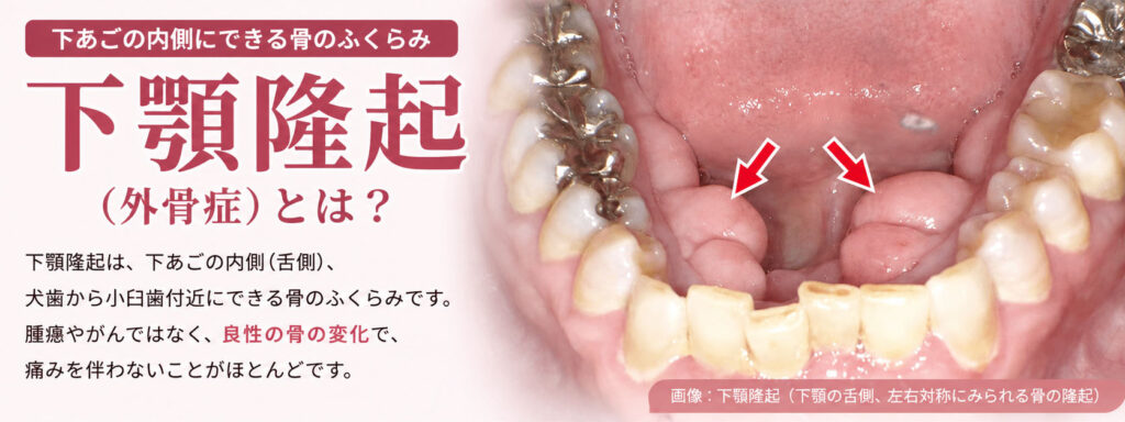 下顎隆起「外骨症」とは