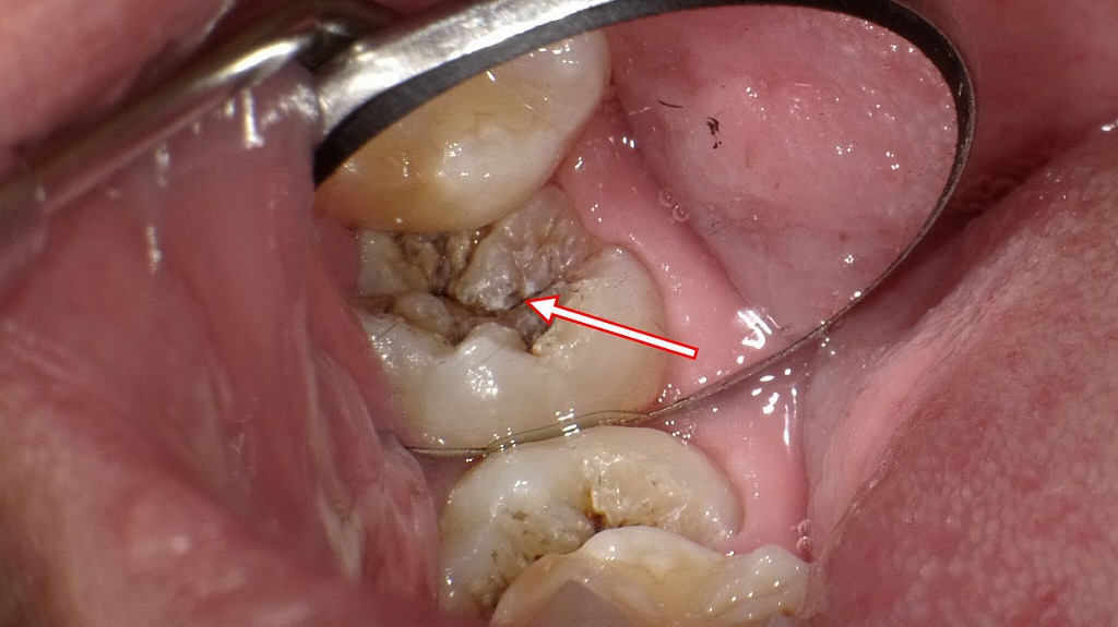 斜めに生えた親知らずの虫歯 ― 鏡で確認される見えにくい病変