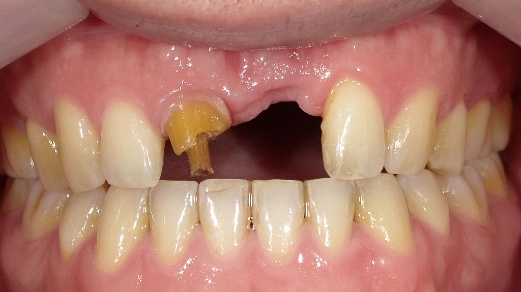 左上1番欠損の術前状態