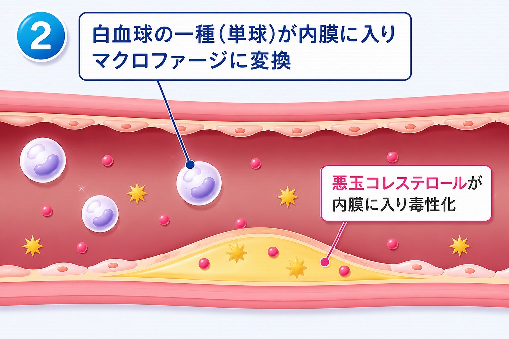 LDLコレステロールが侵入する