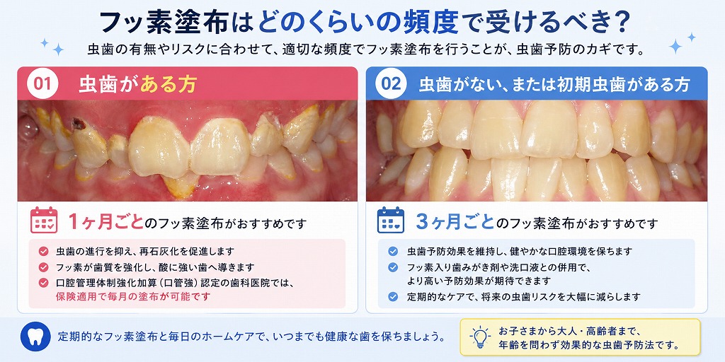 フッ素塗布はどのくらいの頻度で受けるべき？