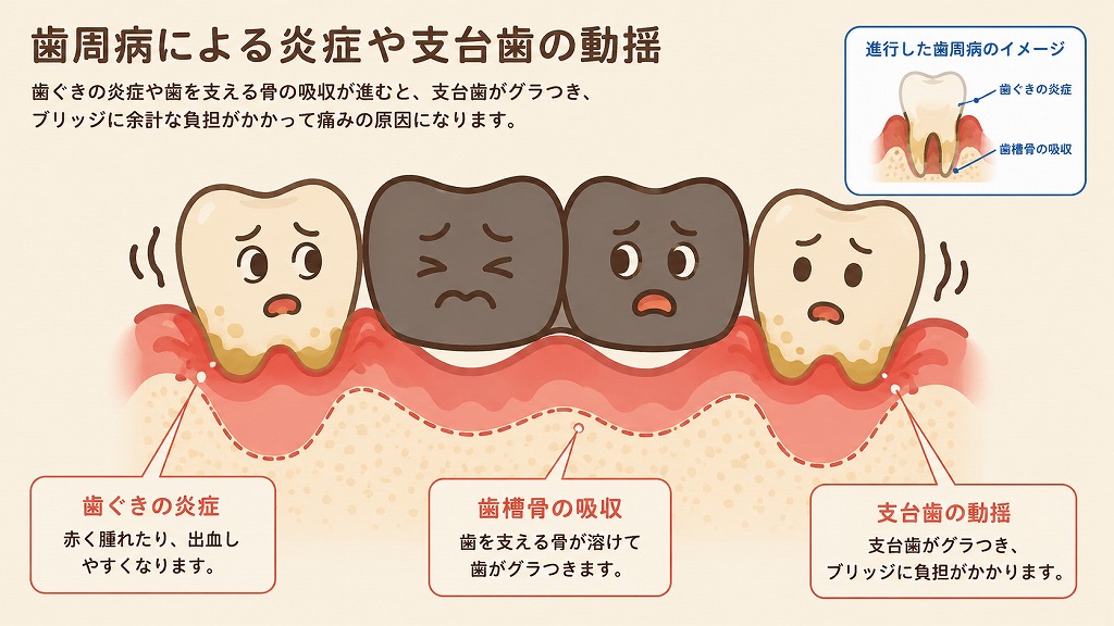 歯周病によるグラつきと炎症