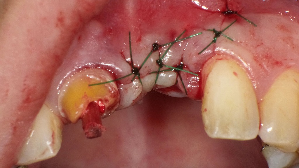 インプラント埋入後の縫合状態